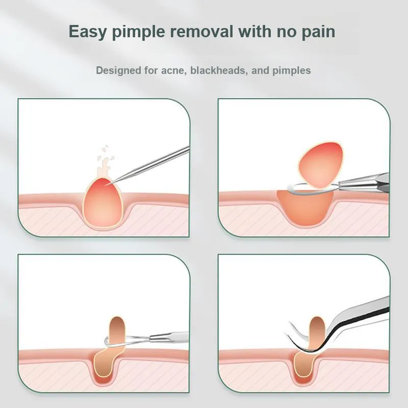 Pleasant Language Stainless Steel Pimple Extraction Tool Combination Blackhead Cell Extractor-4