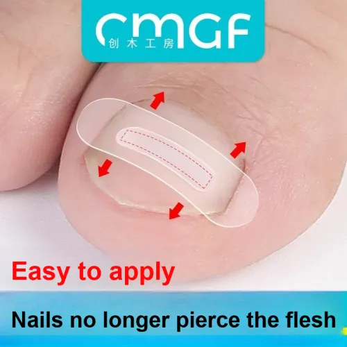 CHUANGMUGONGFANG Отделка Уход за Ногтями Клипсы для Усвоенных Ногтей 10 шт